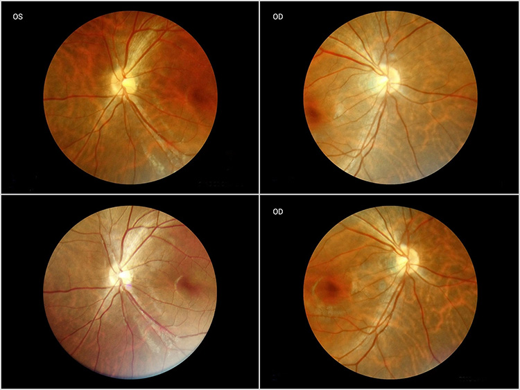 HFC-2 Handheld Fundus Camera